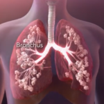 Cystic Fibrosis Homeopathic Treatment